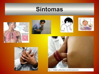 Síntomas
 