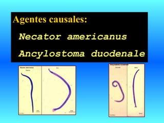 Agentes causales:
Necator americanus
Ancylostoma duodenale
 