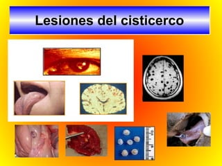 Lesiones del cisticerco
 