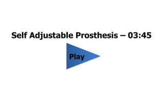 Self Adjustable Prosthesis – 03:45 
Play 
 
