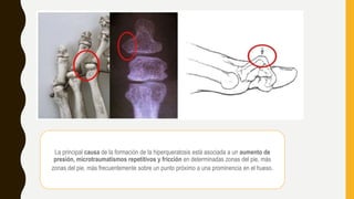 La principal causa de la formación de la hiperqueratosis está asociada a un aumento de
presión, microtraumatismos repetitivos y fricción en determinadas zonas del pie, más
zonas del pie, más frecuentemente sobre un punto próximo a una prominencia en el hueso.
 