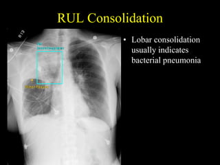 Helpful radiological signs in cxr25 11-91 | PPTX