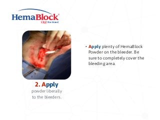 STOP the bleed
2. Apply
powder liberally
to the bleeders.
• Apply plenty of HemaBlock
Powder on the bleeder. Be
sure to completely cover the
bleeding area.
 