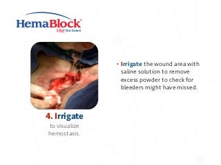 STOP the bleed
4. Irrigate
to visualize
hemostasis.
• Irrigate the wound area with
saline solution to remove
excess powder to check for
bleeders might have missed.
 