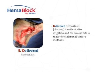 STOP the bleed
5. Delivered
hemostasis.
• Delivered hemostasis
(clotting) is evident after
irrigation and the wound site is
ready for traditional closure
methods.
 