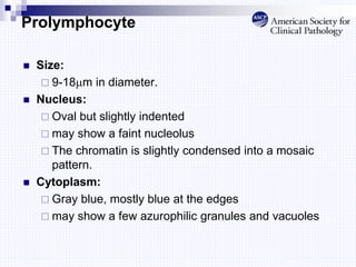 Prolymphocyte
 Size:
 9-18m in diameter.
 Nucleus:
 Oval but slightly indented
 may show a faint nucleolus
 The chromatin is slightly condensed into a mosaic
pattern.
 Cytoplasm:
 Gray blue, mostly blue at the edges
 may show a few azurophilic granules and vacuoles
 