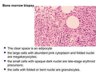 Bone marrow biopsy
 The clear space is an adipocyte
 the large cells with abundant pink cytoplasm and folded nuclei
are megakaryocytes;
 the small cells with opaque dark nuclei are late-stage erythroid
precursors;
 the cells with folded or bent nuclei are granulocytes.
 