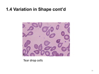1.4 Variation in Shape cont’d
18
Tear drop cells
 