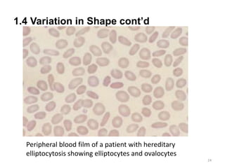 1.4 Variation in Shape cont’d
24
Peripheral blood film of a patient with hereditary
elliptocytosis showing elliptocytes and ovalocytes
 