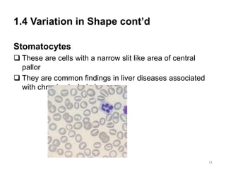 1.4 Variation in Shape cont’d
Stomatocytes
 These are cells with a narrow slit like area of central
pallor
 They are common findings in liver diseases associated
with chronic alcohol abuse
31
 