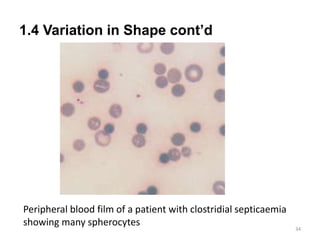 1.4 Variation in Shape cont’d
34
Peripheral blood film of a patient with clostridial septicaemia
showing many spherocytes
 