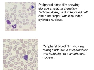 Peripheral blood film showing
storage artefact a crenation
(echinocytosis), a disintegrated cell
and a neutrophil with a rounded
pyknotic nucleus.
Peripheral blood film showing
storage artefact, a mild crenation
and lobulation of a lymphocyte
nucleus.
 