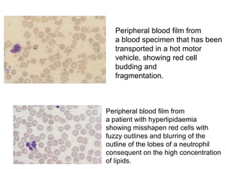 Peripheral blood film from
a blood specimen that has been
transported in a hot motor
vehicle, showing red cell
budding and
fragmentation.
Peripheral blood film from
a patient with hyperlipidaemia
showing misshapen red cells with
fuzzy outlines and blurring of the
outline of the lobes of a neutrophil
consequent on the high concentration
of lipids.
 