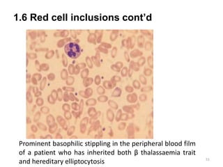 1.6 Red cell inclusions cont’d
51
Prominent basophilic stippling in the peripheral blood film
of a patient who has inherited both β thalassaemia trait
and hereditary elliptocytosis
 
