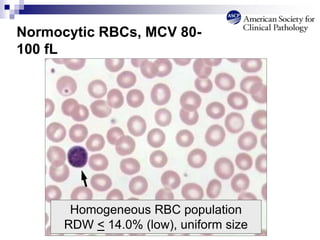 Normocytic RBCs, MCV 80-
100 fL
Homogeneous RBC population
RDW < 14.0% (low), uniform size
 