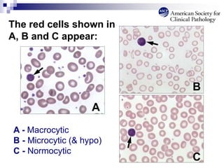 The red cells shown in
A, B and C appear:
A - Macrocytic
B - Microcytic (& hypo)
C - Normocytic
A
B
C
 