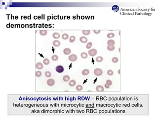 The red cell picture shown
demonstrates:
Anisocytosis with high RDW – RBC population is
heterogeneous with microcytic and macrocytic red cells,
aka dimorphic with two RBC populations
 