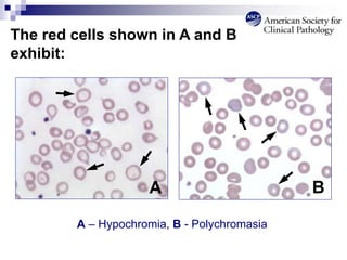 The red cells shown in A and B
exhibit:
A – Hypochromia, B - Polychromasia
B
A
 