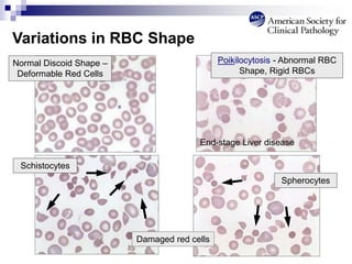 End-stage Liver disease
Spherocytes
Schistocytes
Poikilocytosis - Abnormal RBC
Shape, Rigid RBCs
Normal Discoid Shape –
Deformable Red Cells
Damaged red cells
Variations in RBC Shape
 