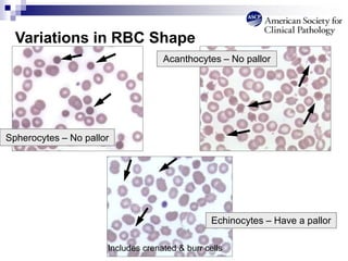Spherocytes – No pallor
Acanthocytes – No pallor
Variations in RBC Shape
Echinocytes – Have a pallor
Includes crenated & burr cells
 