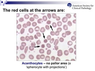 The red cells at the arrows are:
Acanthocytes – no pallor area (a
‘spherocyte with projections’)
 