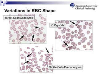 Variations in RBC Shape
Target Cells/Codocytes
C Crystals
Sickle Cells/Drepanocytes
 