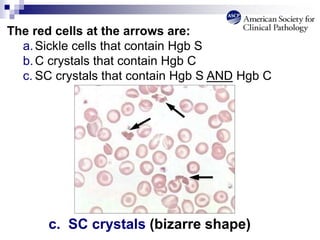 The red cells at the arrows are:
a.Sickle cells that contain Hgb S
b.C crystals that contain Hgb C
c. SC crystals that contain Hgb S AND Hgb C
c. SC crystals (bizarre shape)
 