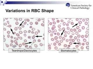 Variations in RBC Shape
Stomatocytes
Teardrops/Dacrocytes
 