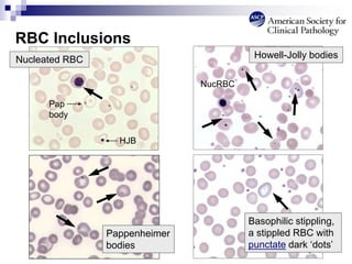 RBC Inclusions
Basophilic stippling,
a stippled RBC with
punctate dark ‘dots’
Howell-Jolly bodies
Pappenheimer
bodies
NucRBC
Nucleated RBC
HJB
Pap
body
 