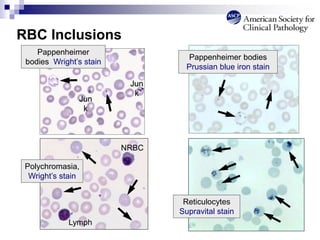 RBC Inclusions
Reticulocytes
Supravital stain
Polychromasia,
Wright’s stain
NRBC
Lymph
Pappenheimer bodies
Prussian blue iron stain
Pappenheimer
bodies Wright’s stain
Jun
k
Jun
k
 