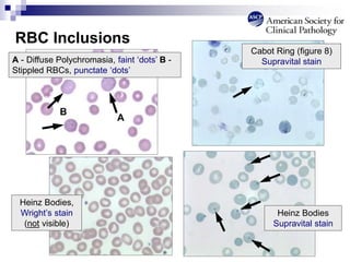 RBC Inclusions
B
A
A - Diffuse Polychromasia, faint ‘dots’ B -
Stippled RBCs, punctate ‘dots’
Cabot Ring (figure 8)
Supravital stain
Heinz Bodies,
Wright’s stain
(not visible)
Heinz Bodies
Supravital stain
 