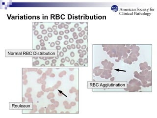 Variations in RBC Distribution
Rouleaux
RBC Agglutination
Normal RBC Distribution
 