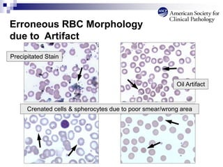 Erroneous RBC Morphology
due to Artifact
Oil Artifact
Precipitated Stain
Crenated cells & spherocytes due to poor smear/wrong area
 