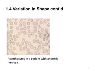 1.4 Variation in Shape cont’d
16
Acanthocytes in a patient with anorexia
nervosa
 