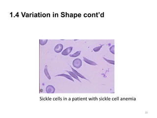 1.4 Variation in Shape cont’d
20
Sickle cells in a patient with sickle cell anemia
 