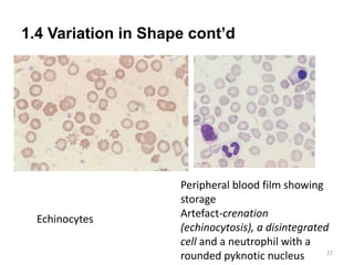 1.4 Variation in Shape cont’d
22
Echinocytes
Peripheral blood film showing
storage
Artefact-crenation
(echinocytosis), a disintegrated
cell and a neutrophil with a
rounded pyknotic nucleus
 