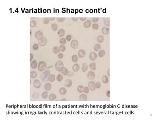 1.4 Variation in Shape cont’d
30
Peripheral blood film of a patient with hemoglobin C disease
showing irregularly contracted cells and several target cells
 