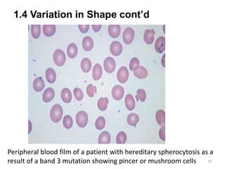 1.4 Variation in Shape cont’d
33
Peripheral blood film of a patient with hereditary spherocytosis as a
result of a band 3 mutation showing pincer or mushroom cells
 