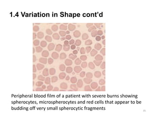 1.4 Variation in Shape cont’d
35
Peripheral blood film of a patient with severe burns showing
spherocytes, microspherocytes and red cells that appear to be
budding off very small spherocytic fragments
 