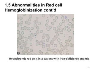 1.5 Abnormalities in Red cell
Hemoglobinization cont’d
42
Hypochromic red cells in a patient with iron-deficiency anemia
 