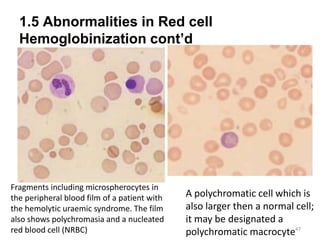 1.5 Abnormalities in Red cell
Hemoglobinization cont’d
47
Fragments including microspherocytes in
the peripheral blood film of a patient with
the hemolytic uraemic syndrome. The film
also shows polychromasia and a nucleated
red blood cell (NRBC)
A polychromatic cell which is
also larger then a normal cell;
it may be designated a
polychromatic macrocyte
 