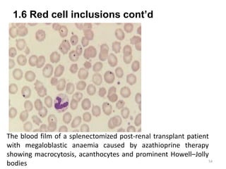 1.6 Red cell inclusions cont’d
54
The blood film of a splenectomized post-renal transplant patient
with megaloblastic anaemia caused by azathioprine therapy
showing macrocytosis, acanthocytes and prominent Howell–Jolly
bodies
 