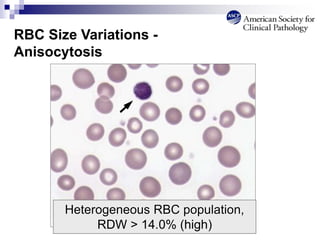 RBC Size Variations -
Anisocytosis
Heterogeneous RBC population,
RDW > 14.0% (high)
 