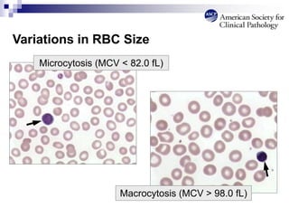 Variations in RBC Size
Microcytosis (MCV < 82.0 fL)
Macrocytosis (MCV > 98.0 fL)
 