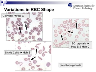 Variations in RBC Shape
C crystal Hgb C
SC crystals 
Hgb S & Hgb C
Sickle Cells  Hgb S
Note the target cells
 
