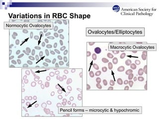 Variations in RBC Shape
Pencil forms – microcytic & hypochromic
Ovalocytes/Elliptocytes
Normocytic Ovalocytes
Macrocytic Ovalocytes
 
