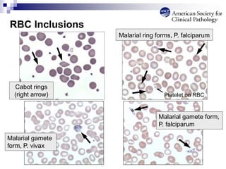 RBC Inclusions
Malarial gamete
form, P. vivax
Malarial gamete form,
P. falciparum
Malarial ring forms, P. falciparum
Platelet on RBC
Cabot rings
(right arrow)
 