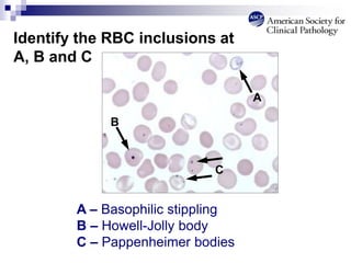 Identify the RBC inclusions at
A, B and C
A – Basophilic stippling
B – Howell-Jolly body
C – Pappenheimer bodies
B
C
A
 