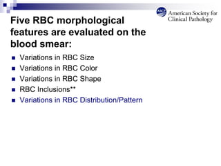  Variations in RBC Size
 Variations in RBC Color
 Variations in RBC Shape
 RBC Inclusions**
 Variations in RBC Distribution/Pattern
Five RBC morphological
features are evaluated on the
blood smear:
 