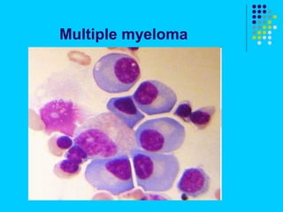 Multiple myeloma
 
